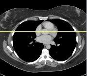 chest CT scan with slice through heart and lungs