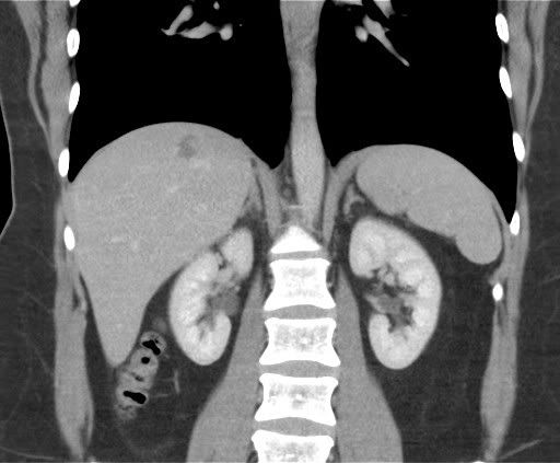 CT scan of abdomen showing kidneys that look like embryos