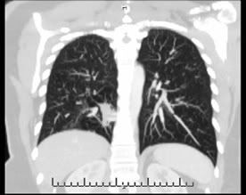 CT scan with contrast showing mucous plug in right lung