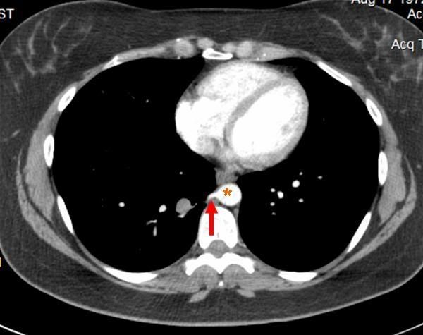 CT scan pointing out aortic branch