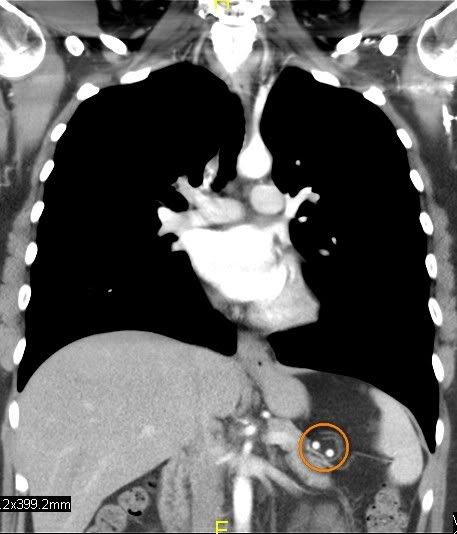CT scan of chest, vertical slice