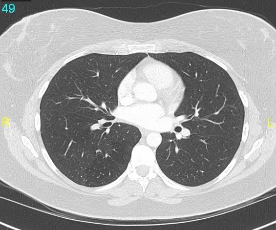 chest CT scan showing heart, lungs, and blood vessels.