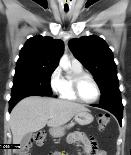 CT scan, vertical slice with hole in neck