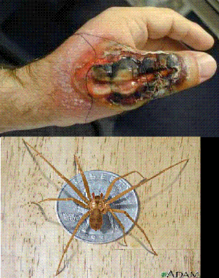 brown recluse spider bite pictures. Brown Recluse Spider Bite