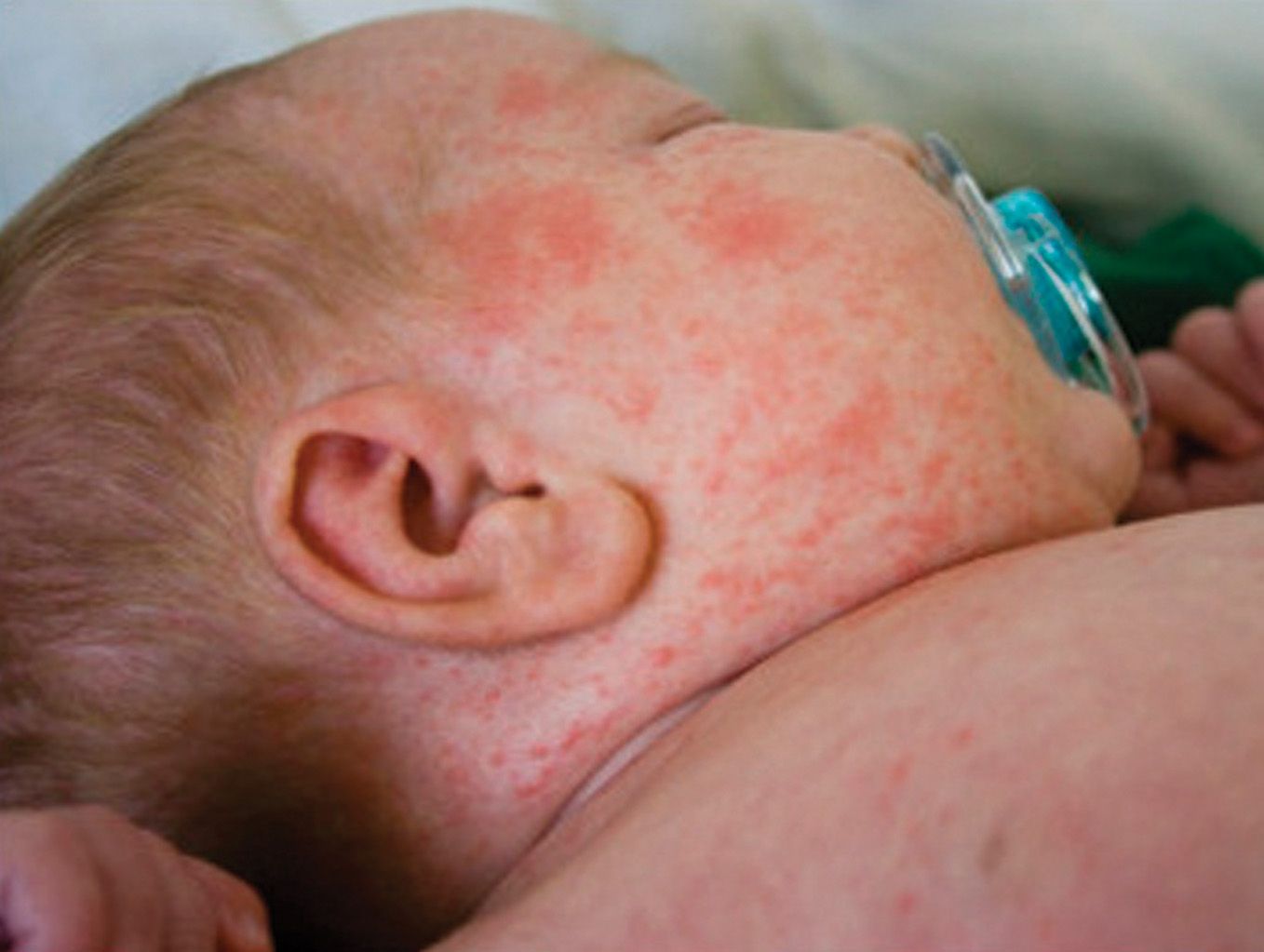 Measles Outbreak photo measles1_zpsq9ux2yxk.jpg