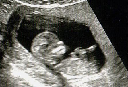 Baby at 11 weeks 6 days